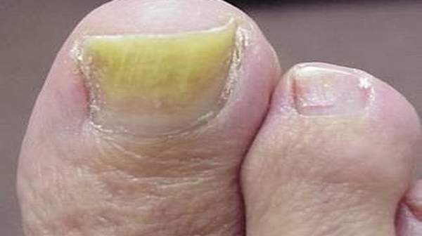 fungal-nail-infections-quick-fact-on-causes-treatments-health-digest