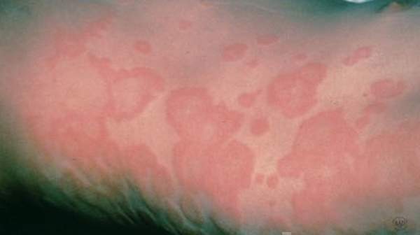 hives-characteristic-and-causes-health-digest