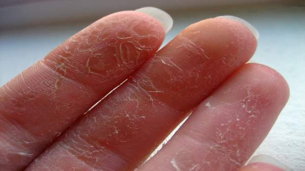 fingertips-peeling-5-tips-to-get-rid-of-peeling-skin-from-fingertips