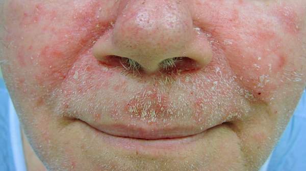 Seborrheic Dermatitis In Adults Causes Symptoms And Treatments Health Digest