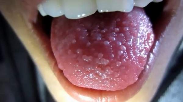 White Papillae On Tongue