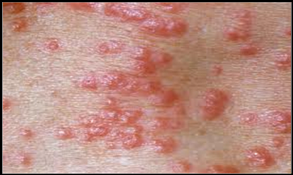 Scabies rash close up