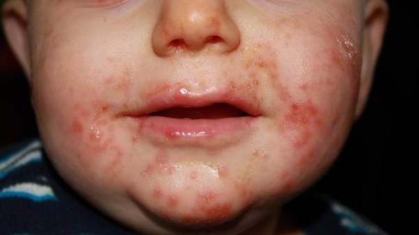 How to Prevent Hand-Foot-and-Mouth Disease | Digest Ground