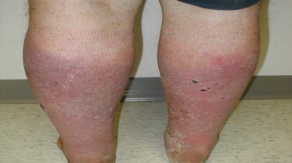 Stasis Dermatitis Pictures Symptoms Causes Treatment Diagnosis Images