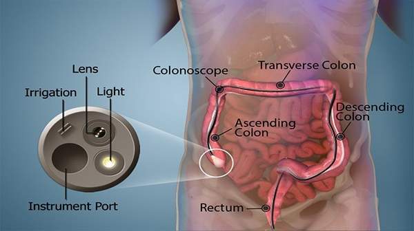 colonoscopy after effects