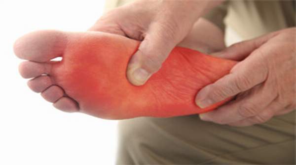 burning arch pain in foot
